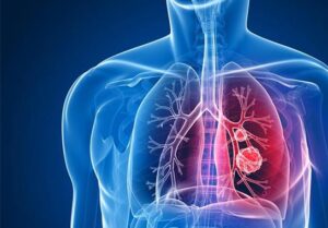 Tuberculose tem cura; conheça a atuação do Ministério da Saúde para eliminar a doença no Brasil - Portal ZUG - Vale do Aço